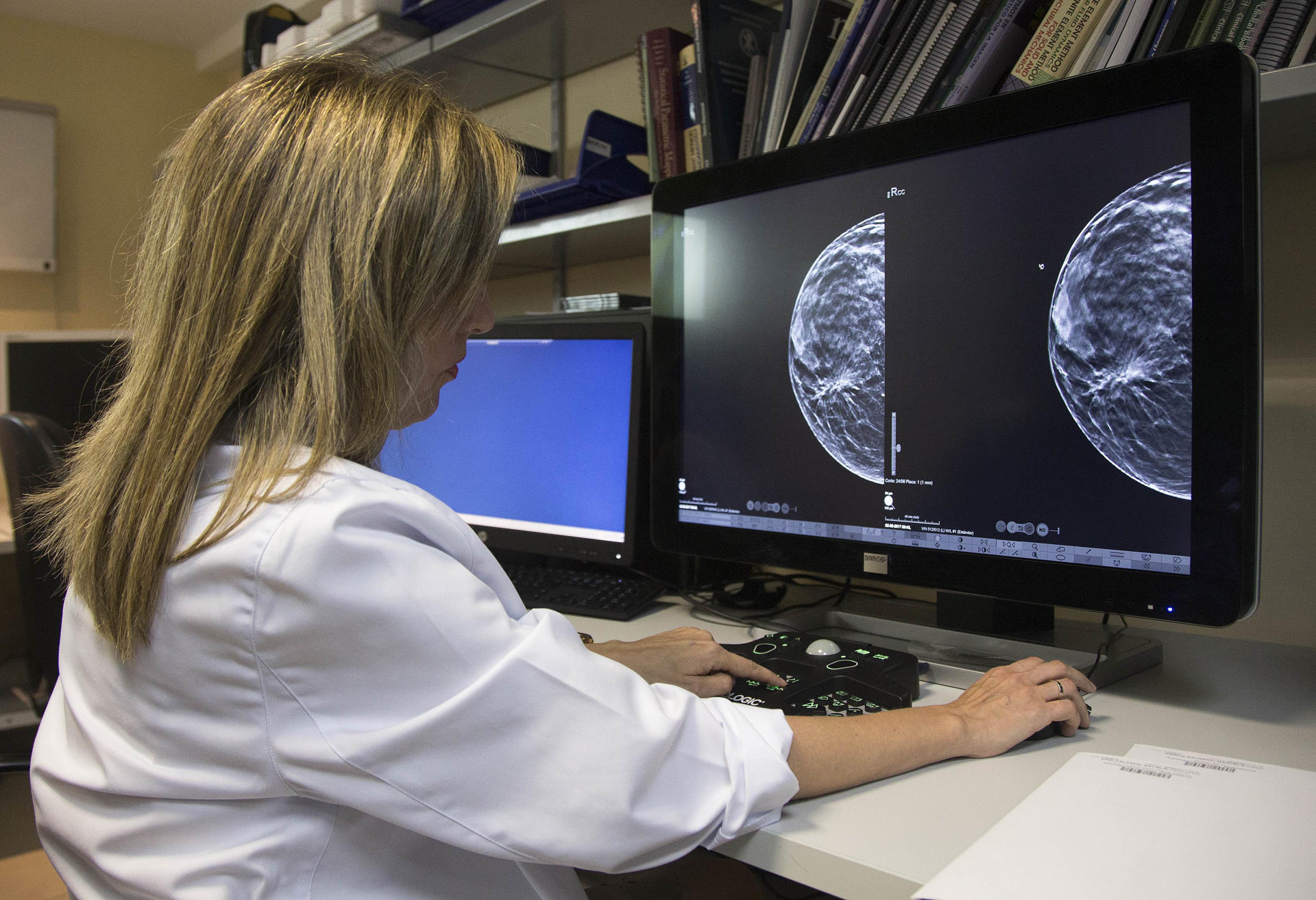 conselleria elimina segunda mamografia
