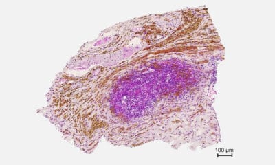 Un nuevo tratamiento contra el cáncer de páncreas estimula las defensas y frena el crecimiento tumoral en ratones