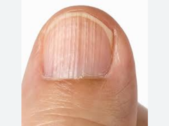 rayas en las uñas