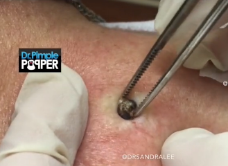 VÍDEO| Una doctora publica en sus redes la extracción de una espinilla del tamaño de una bala
