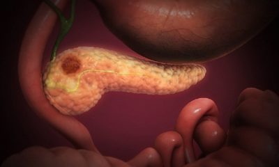 AVANCE| El CSIC descubre cómo detectar el cáncer de páncreas a través de un análisis de sangre