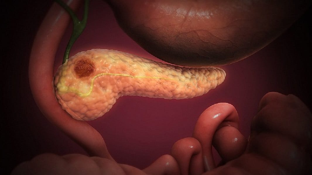 AVANCE| El CSIC descubre cómo detectar el cáncer de páncreas a través de un análisis de sangre