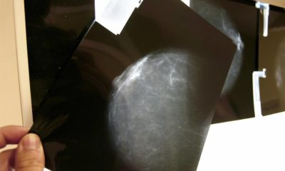 nuevo fármaco cáncer de mama
