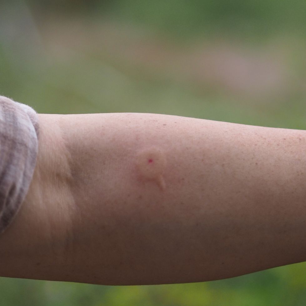 15 fotos que te ayudarán a saber qué insecto te ha picado
