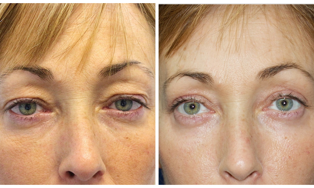 Blefaroplastia en Valencia: tratamiento para rejuvenecer tu mirada