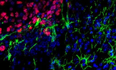 metástasis cerebrales cáncer piel