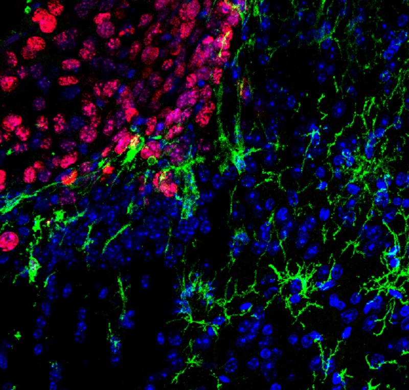 metástasis cerebrales cáncer piel