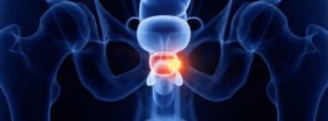 avance cáncer próstata