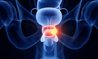 avance cáncer próstata