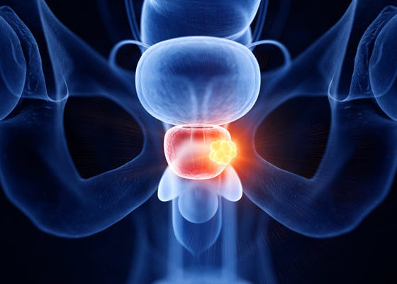 avance cáncer próstata