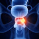 avance cáncer próstata