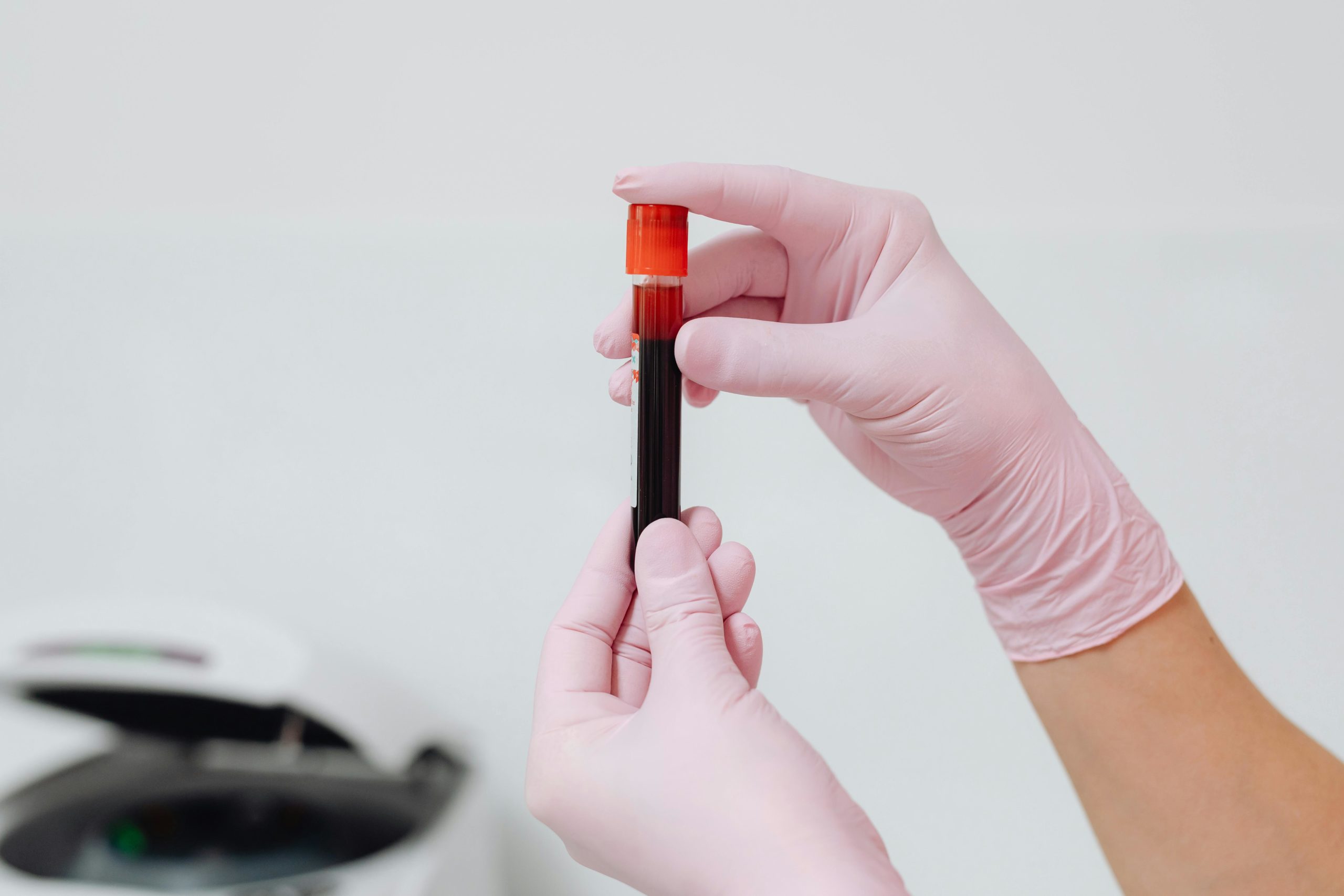 análisis detección esclerosis múltiple